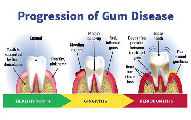Stages of gum disease and changes around the teeth