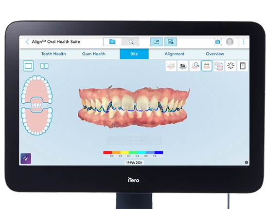 Dental technology display showing an iTero 3D bite scan