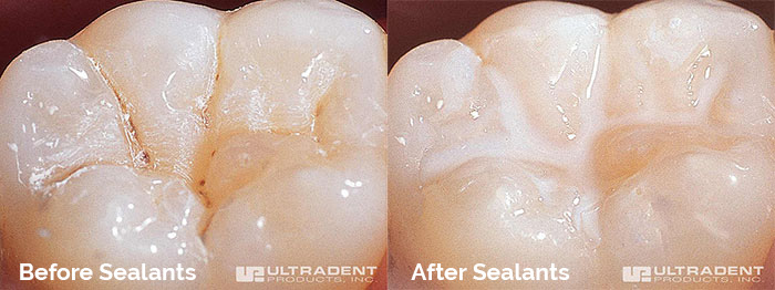 Cavity prevention with dental sealants: tooth before and after application