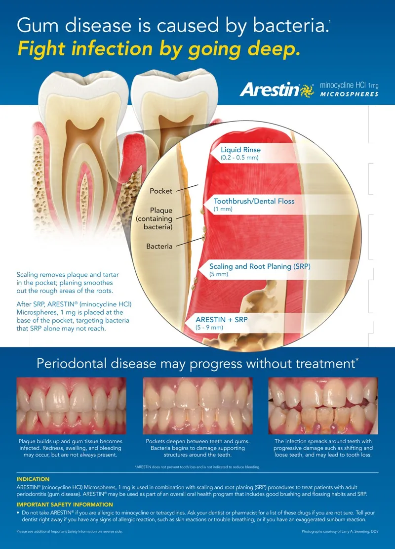 Arestin diagram showing antibiotic placement in periodontal pockets after scaling and root planing