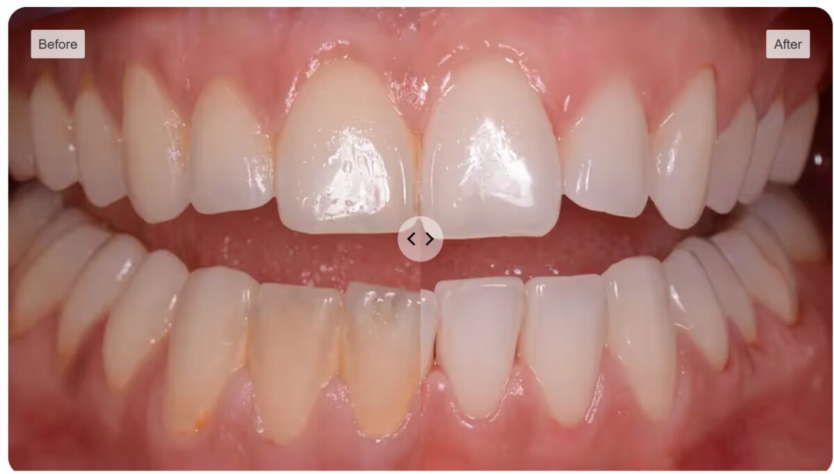 Before-and-after professional dental cleaning comparison, example 1
