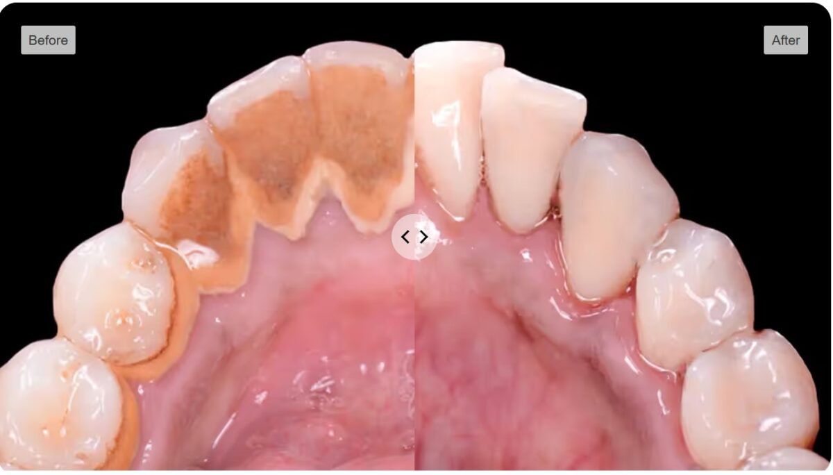 Before-and-after professional dental cleaning comparison, example 2
