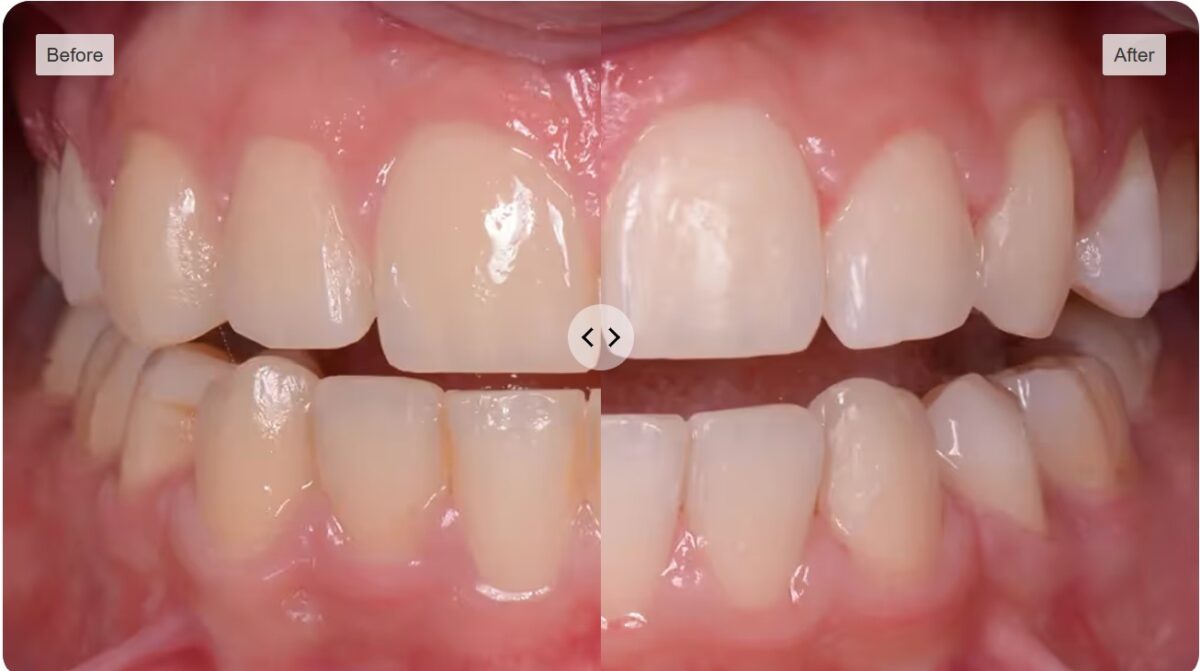 Before-and-after professional dental cleaning comparison, example 3