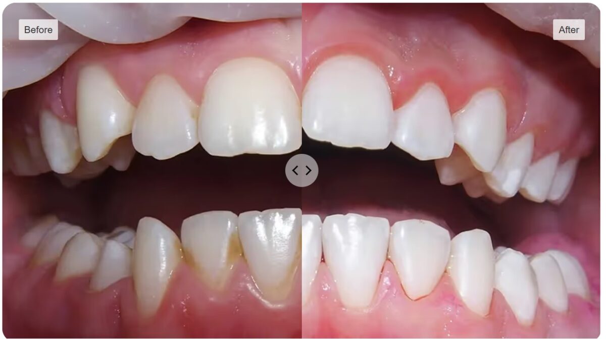 Before-and-after professional dental cleaning comparison, example 4