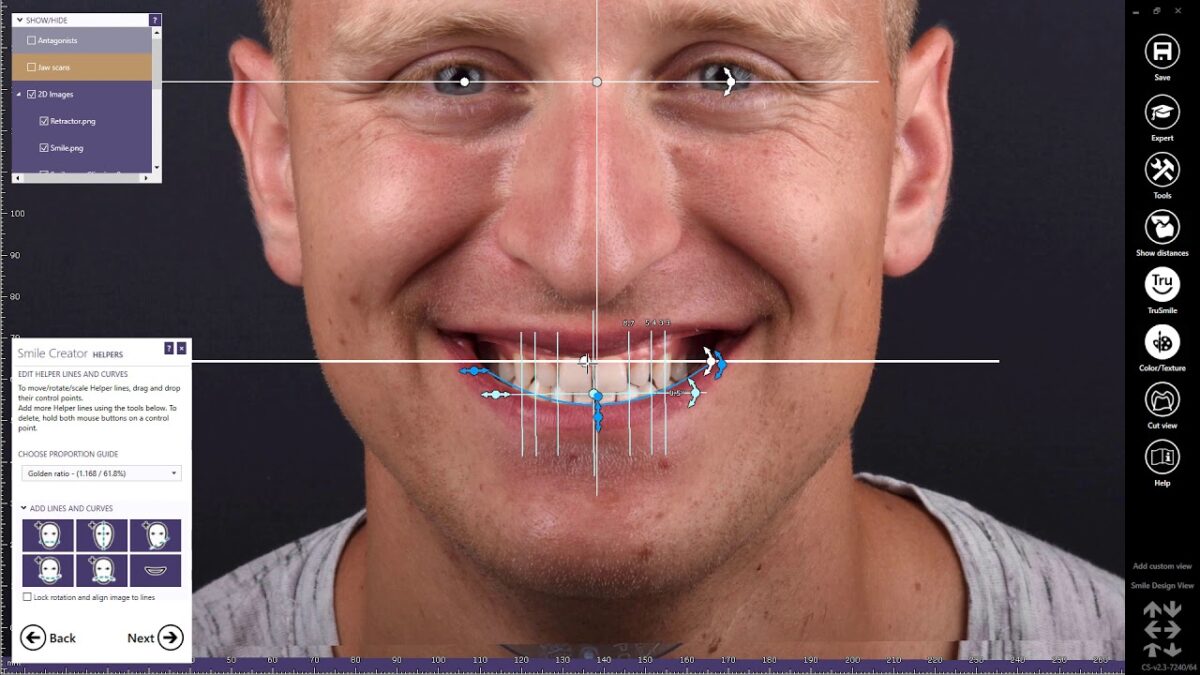 Exocad smile design software displaying a digital smile plan