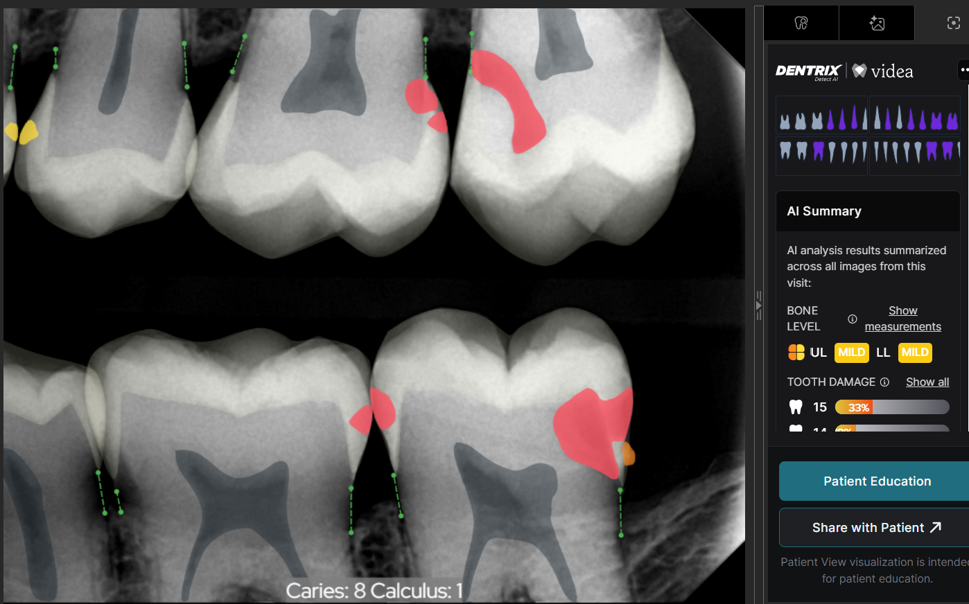 Dental X-ray with AI-highlighted areas for decay review and bone-level measurement markers.