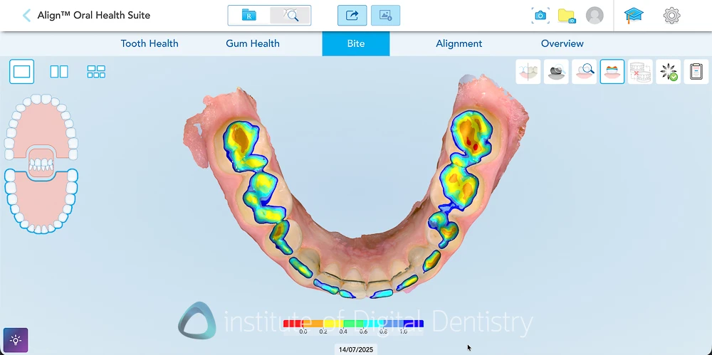 iTero Lumina 3D scan showing color-coded bite contacts in the Align Oral Health Suite